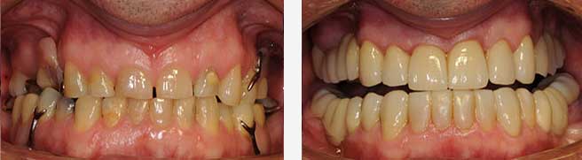 Full Bite Reconstruction