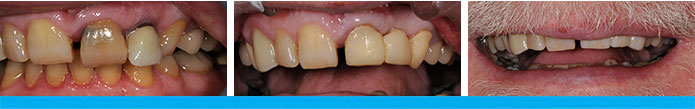 Dental Bridge Before & After