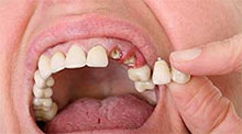 Broken Dental Implant