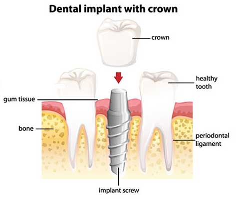 Crowns attached to Dental Implants