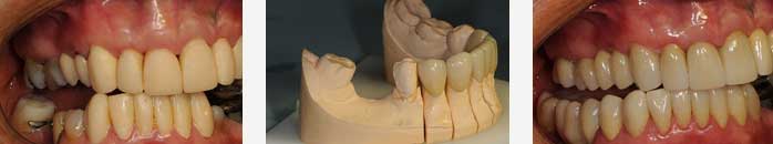 Dental Bridges