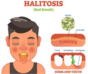 Halitosis - Bad Breath