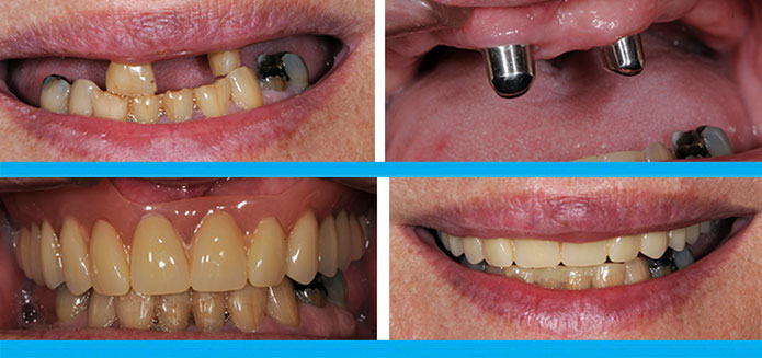 Telescopic Denture Before & After