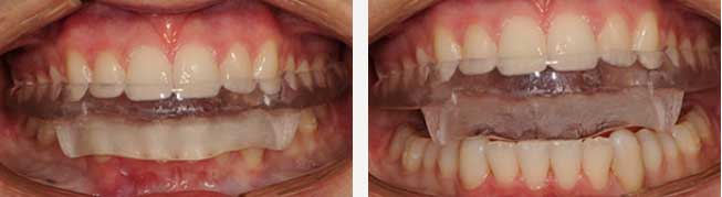 Tmj Splints Retainer SEQDentalSpecialist